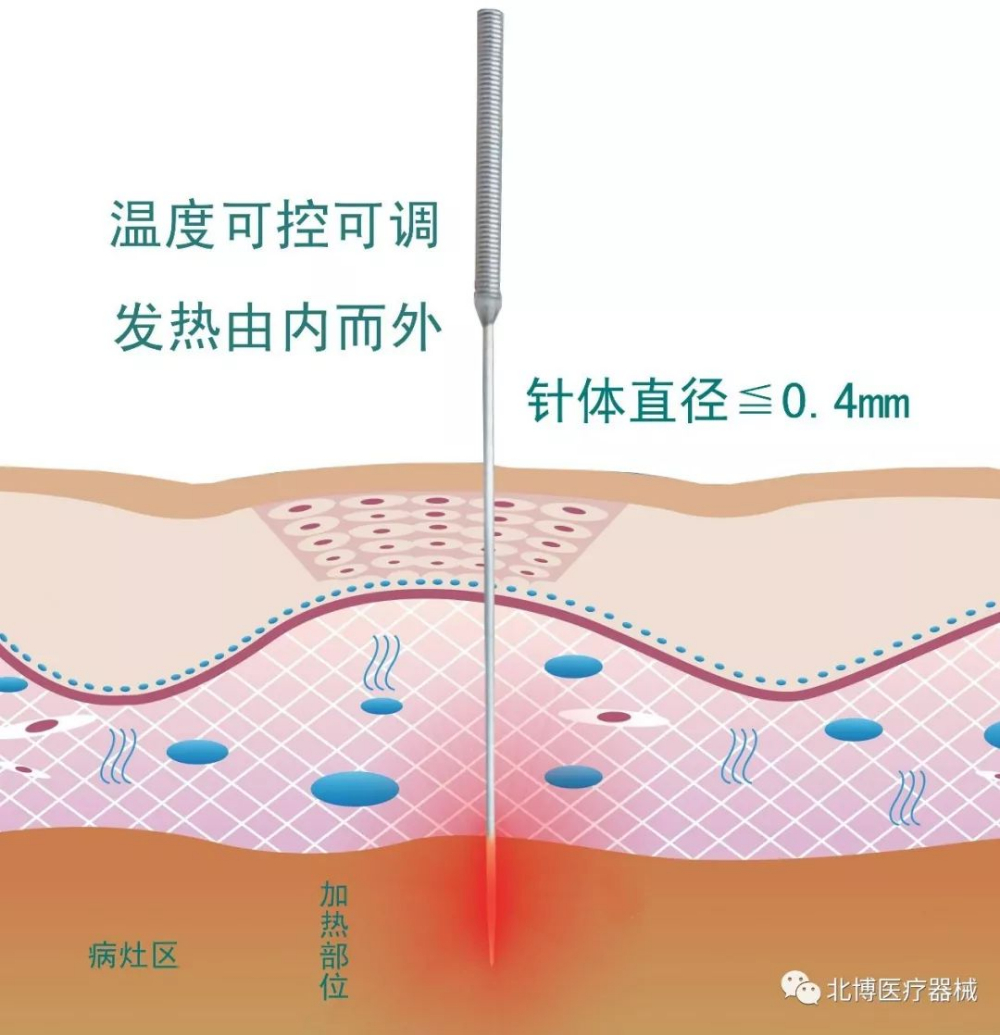 治療儀3